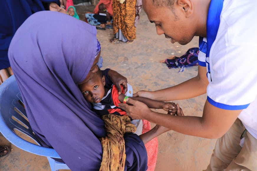 Ondervoed kind wordt geholpen door dokter in Somalië